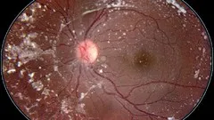 Retinal Atlas: Hereditary Chorioretinal Dystrophy