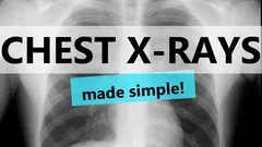 Chest X-ray Interpretation