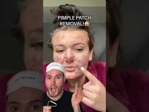 EXTREME PIMPLE PATCH REMOVAL! (follow for more!) #beauty #skincare #skincareroutine #acne #skin
